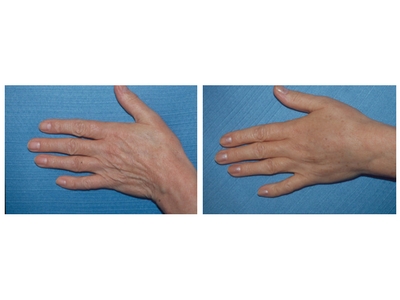 Pomladivanje ruku pre-posle | Clinic Olymp