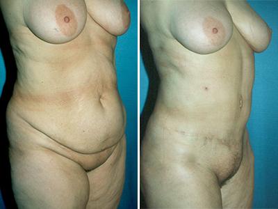 Zatezanje stomaka - plastična operacija stomaka - pre-posle | Clinic Olymp
