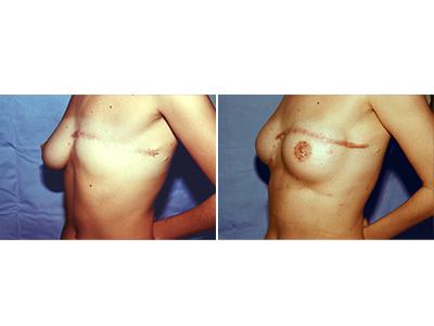 Rekonstrukcija dojke pre-posle | Clinic Olymp