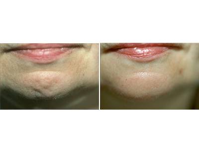 Korekcija brade pre-posle | Clinic Olymp
