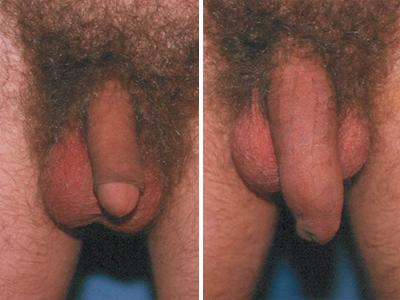 Povećanje penisa pre-posle | Clinic Olymp