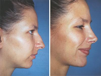 Operacija nosa - pre-posle | Clinic Olymp